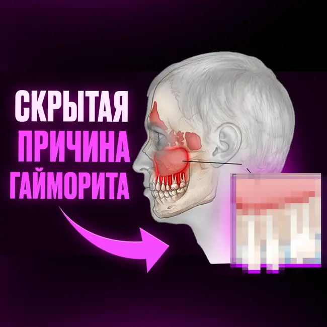 КАК ИЗБАВИТСЯ ОТ ГАЙМОРИТА НАВСЕГДА? УСТРАНИ ПРИЧИНУ